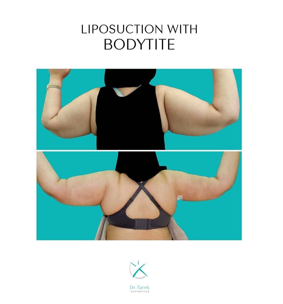 Body Sculpting And Skin Tightening Got Easier With Bodytite