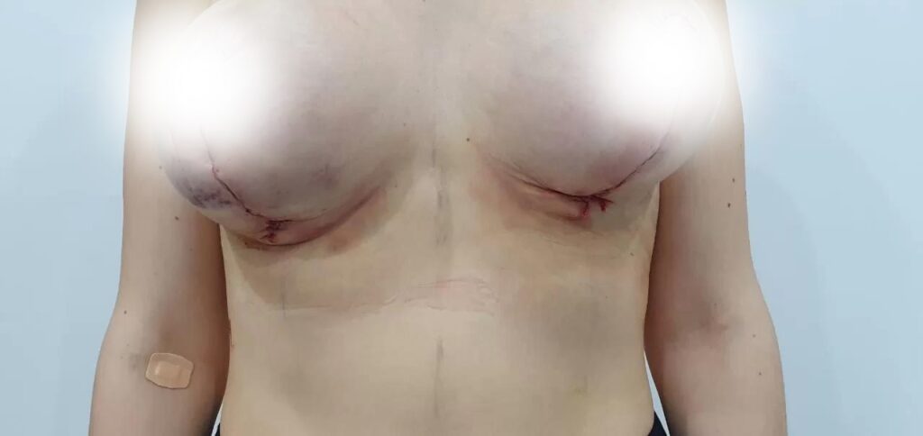 Short Scar Vertical Mastopexy, With Fat Equalization