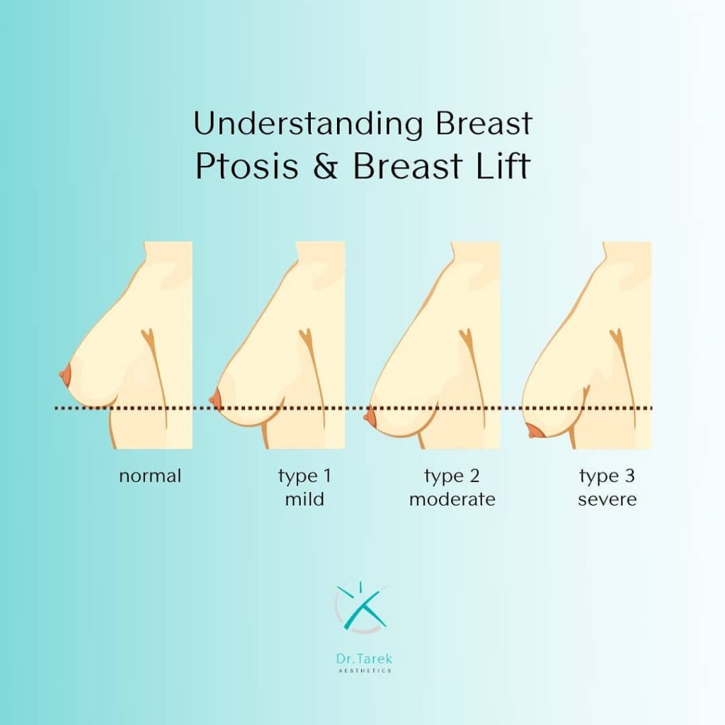 Best Breast Lift Surgery In Dubai By Dr Tarek Aesthetics