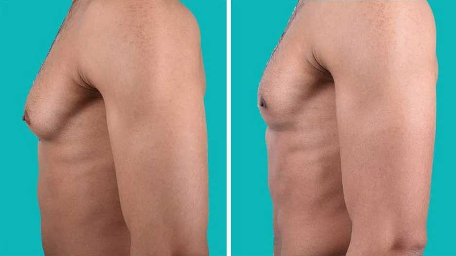 Comparison of chest circumference before and after ketogenic therapy.