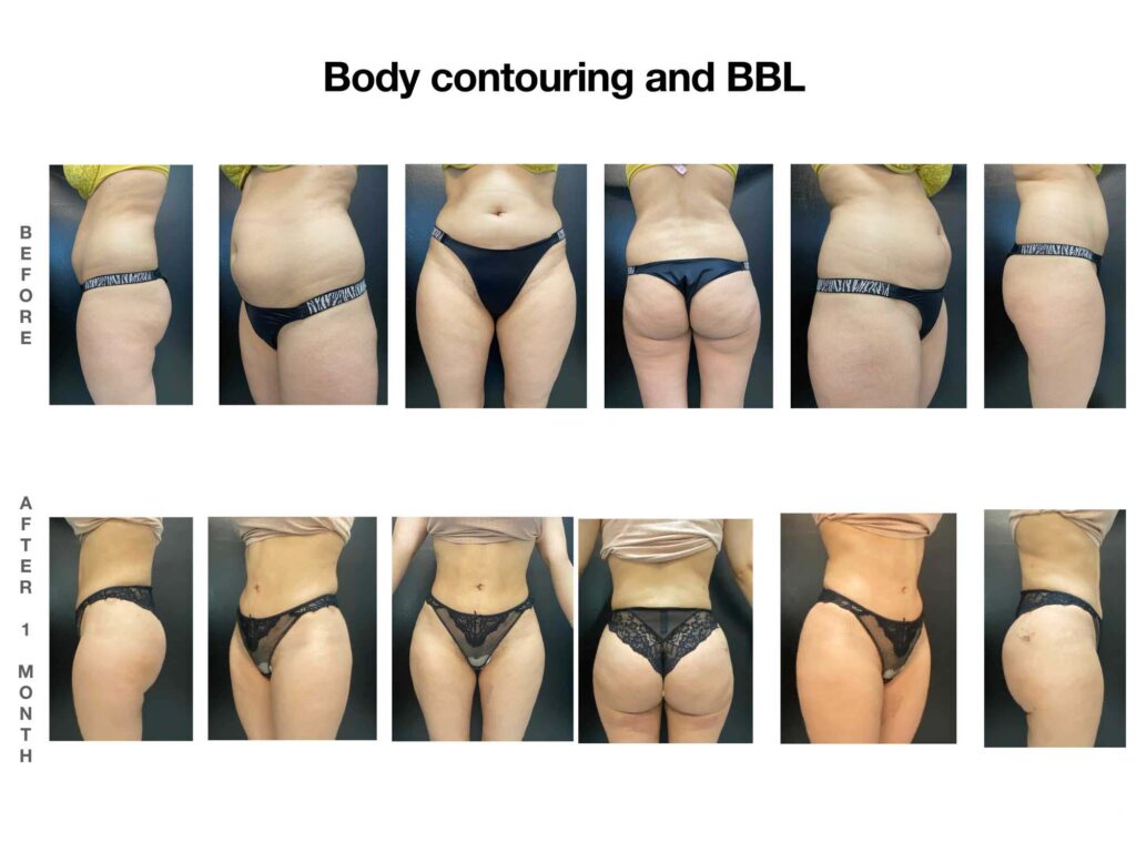 Body Contouring And BBL Gallery 2024