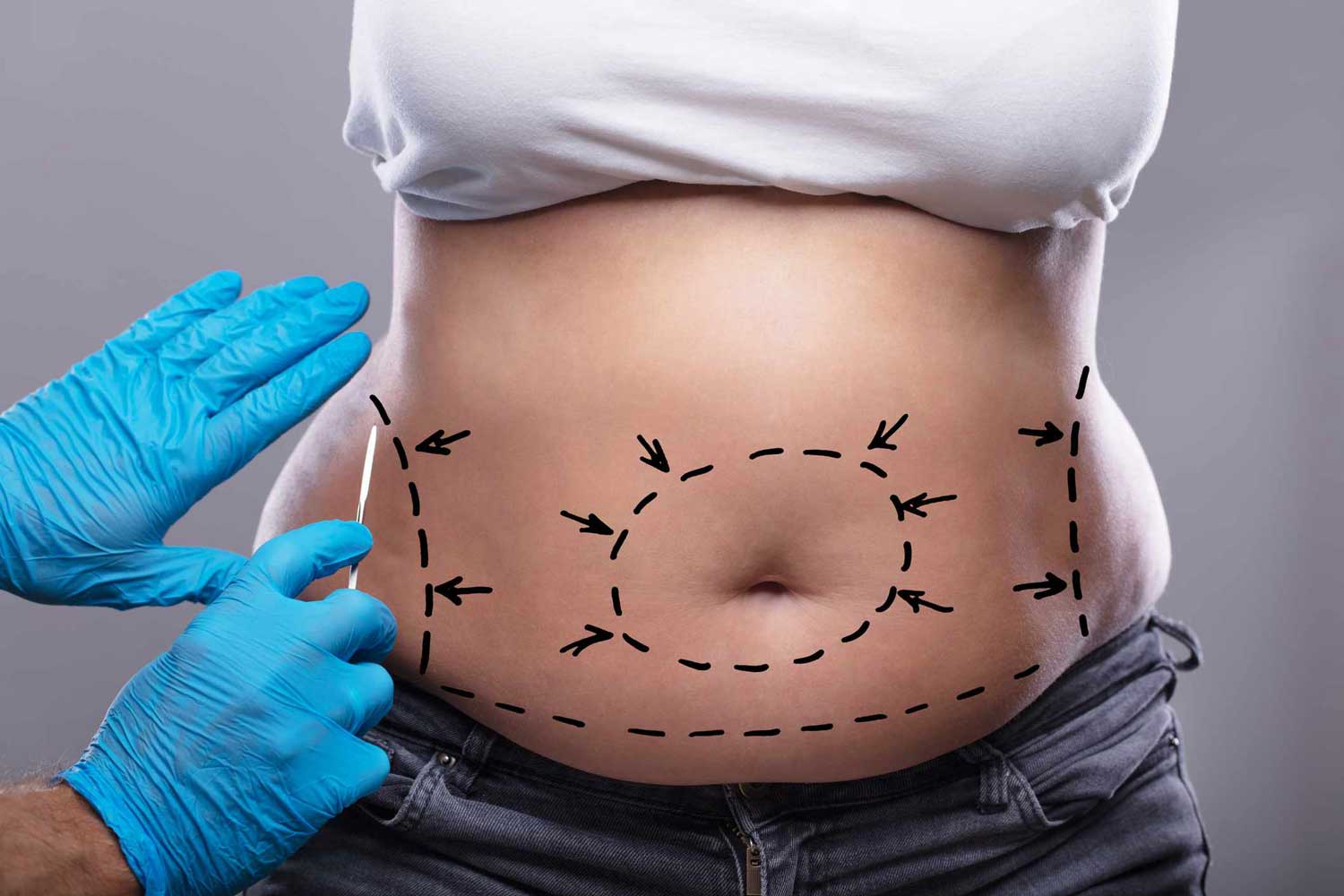 How To Prepare For Tummy Tuck And Liposuction Surgeries 2024