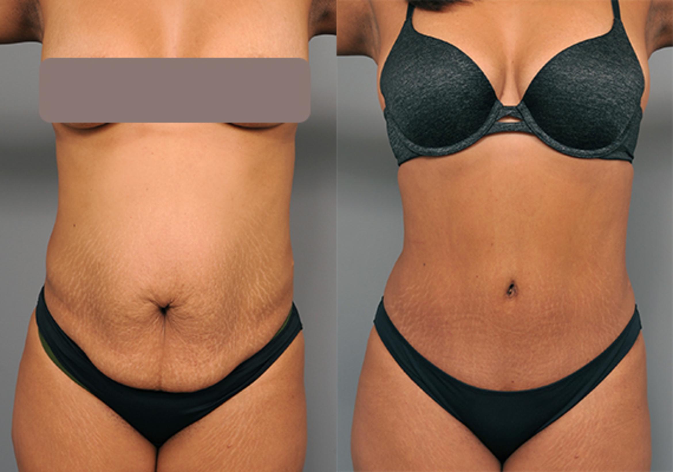 Should you add liposuction to your tummy tuck?