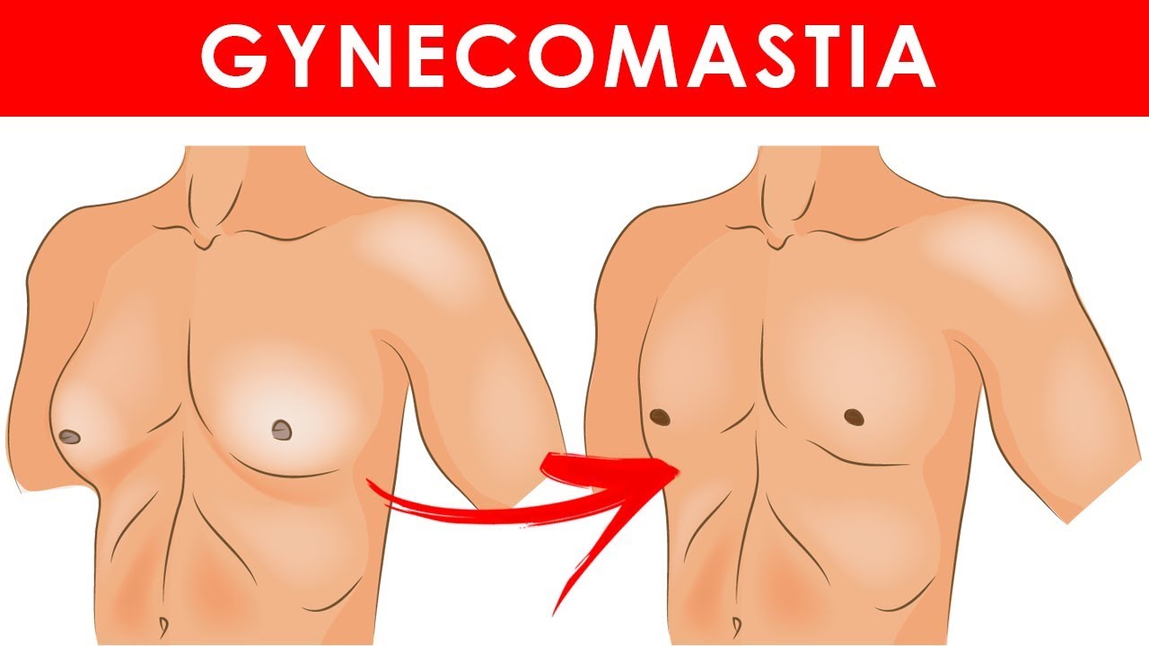 How to Get Rid of Man Boobs (Moobs): Strategies for Treating Gynecom –  Transparent Labs