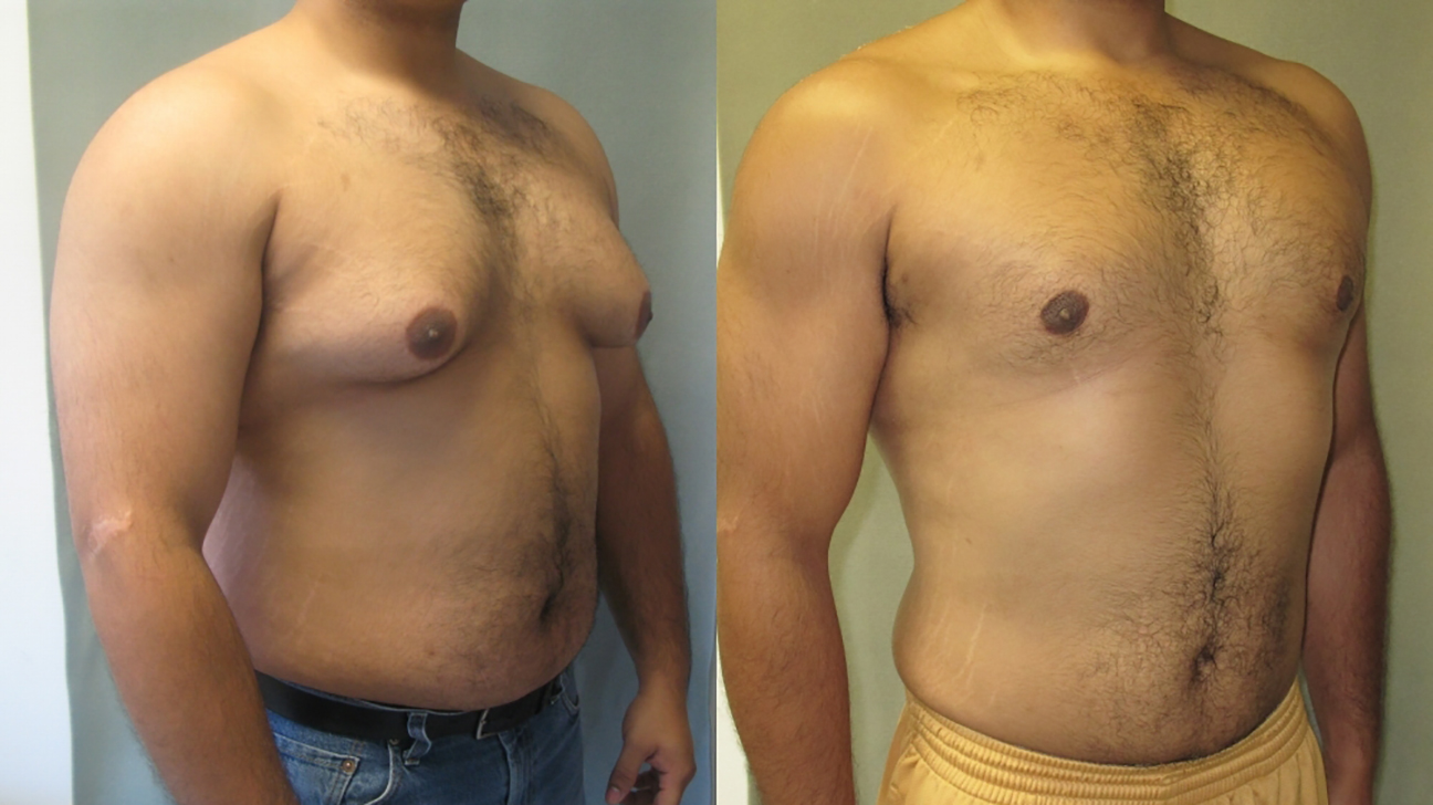 Effective Tips on Shaping the Chest after Gynecomastia Surgery