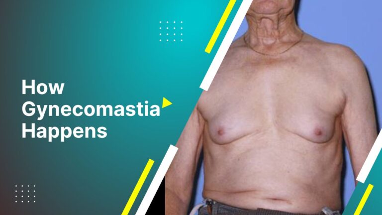 How Gynecomastia Happens