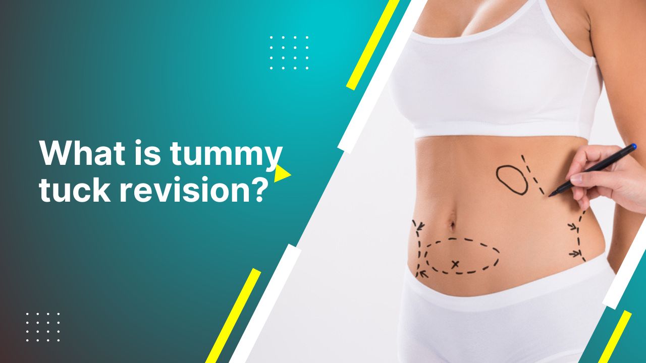 Tummy Tuck - Corrective/Revision Before and After Results