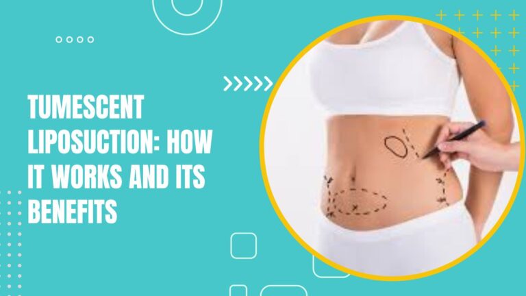 Tumescent Liposuction How It Works And Its Benefits