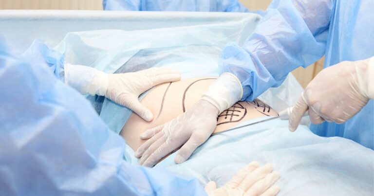 Liposuction For Large Lipomas How It Can Be A Safe And Effective Treatment