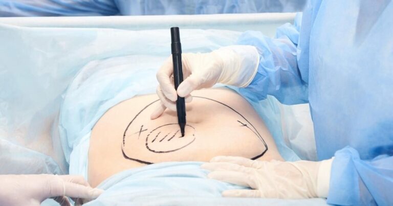 Multiple Sessions Liposuction: Benefits, Risks And What To Expect