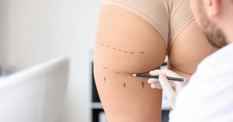 Buttocks Liposuction In Dubai