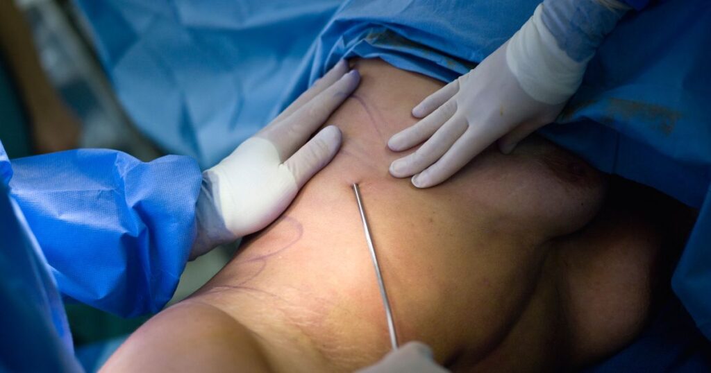 Liposuction Procedure