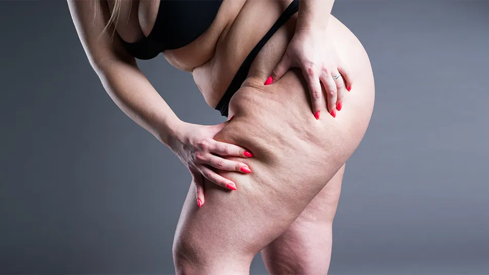 Patient with stage 2 lipedema (A), showing a slight improvement