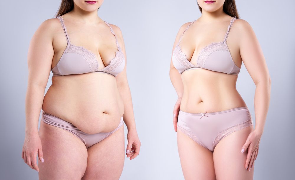 Full body Liposuction, Body contouring