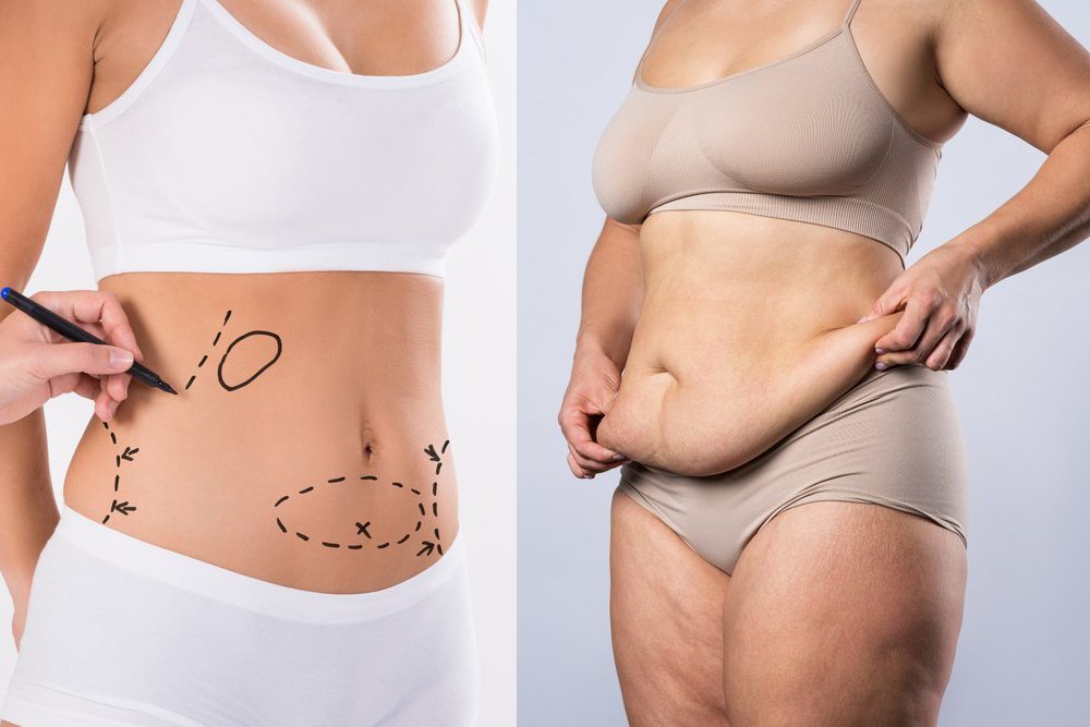 The Body Sculpting Center - Belly buttons - they're a huge factor