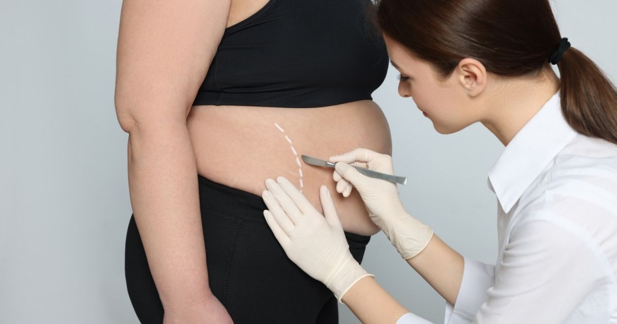 Lady Doctor Is Marking On Belly For Fat Removal Procedure