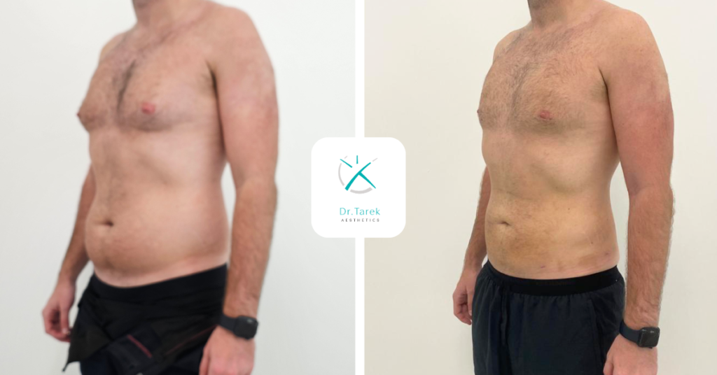 Men’S Liposuction Before And After