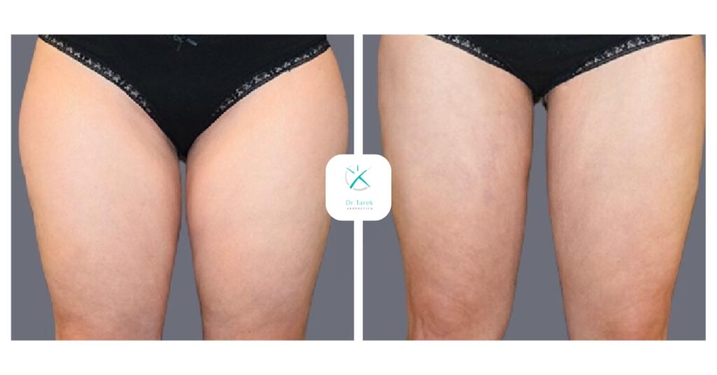 Thigh Liposuction Before And After