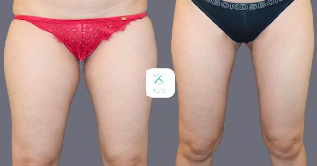 Thigh Liposuction Before And After