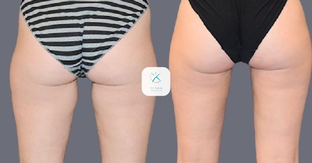 Thigh Liposuction Before And After