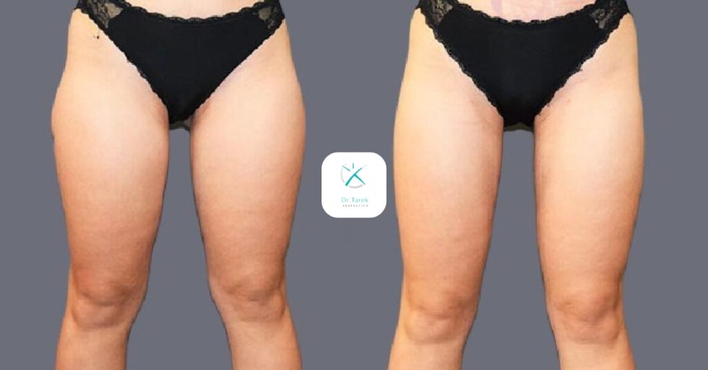 Thigh Liposuction Before And After