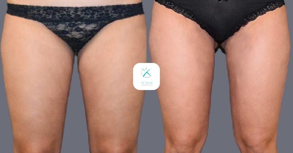 Thigh Liposuction Before And After