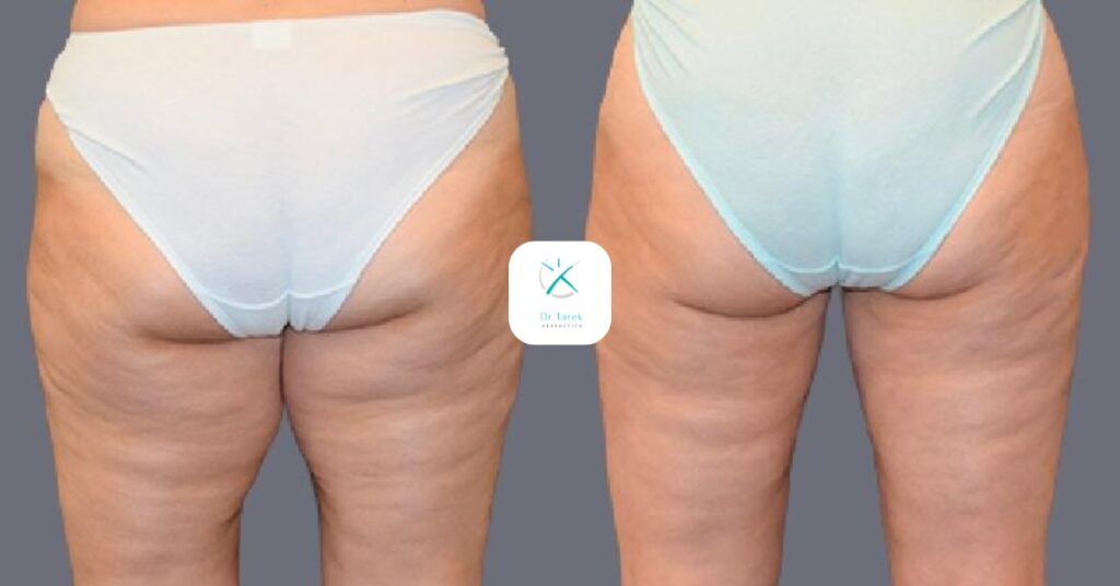 Thigh Liposuction Before And After