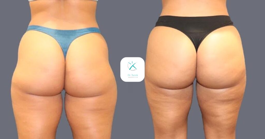 Thigh Liposuction Before And After