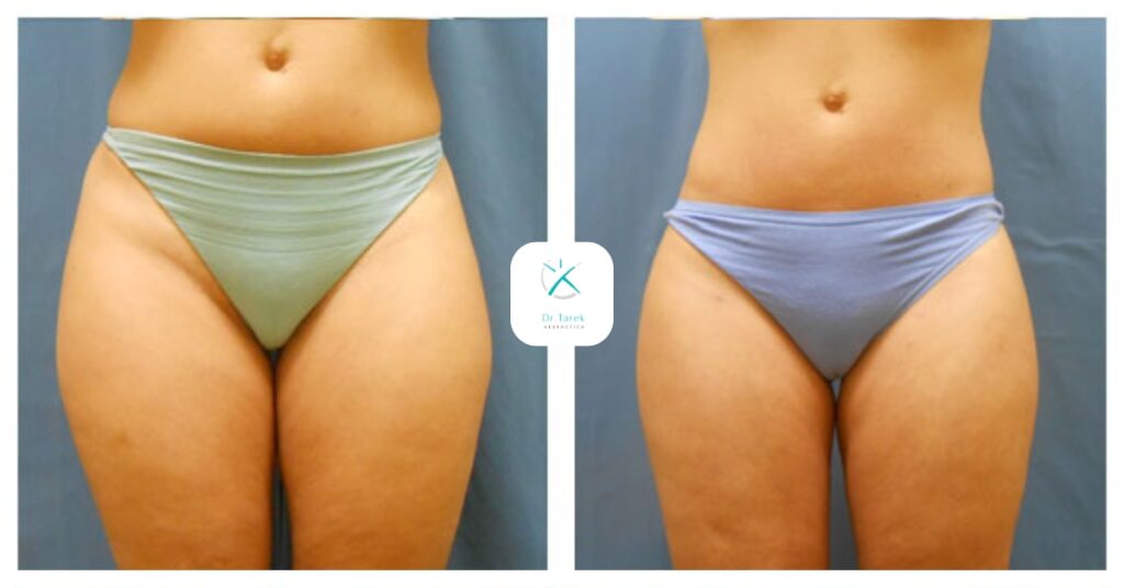 Thigh Liposuction Before and After