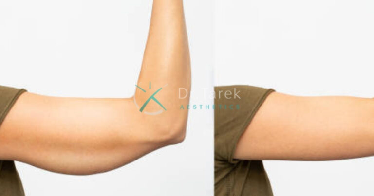 Arm Liposuction Before And After