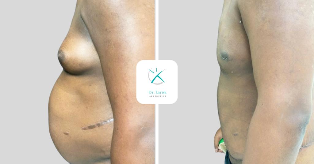 Men’S Liposuction Before And After