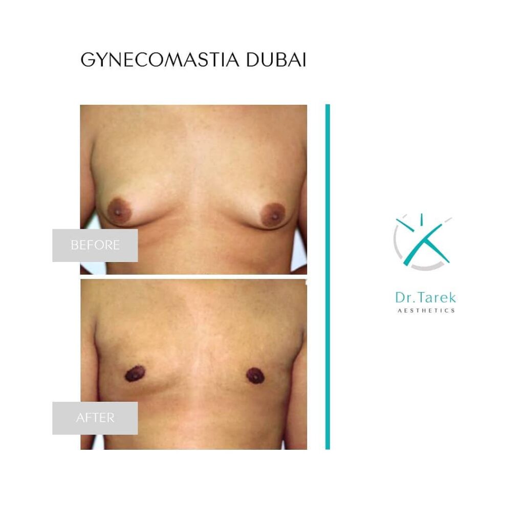 Men’S Liposuction Before And After