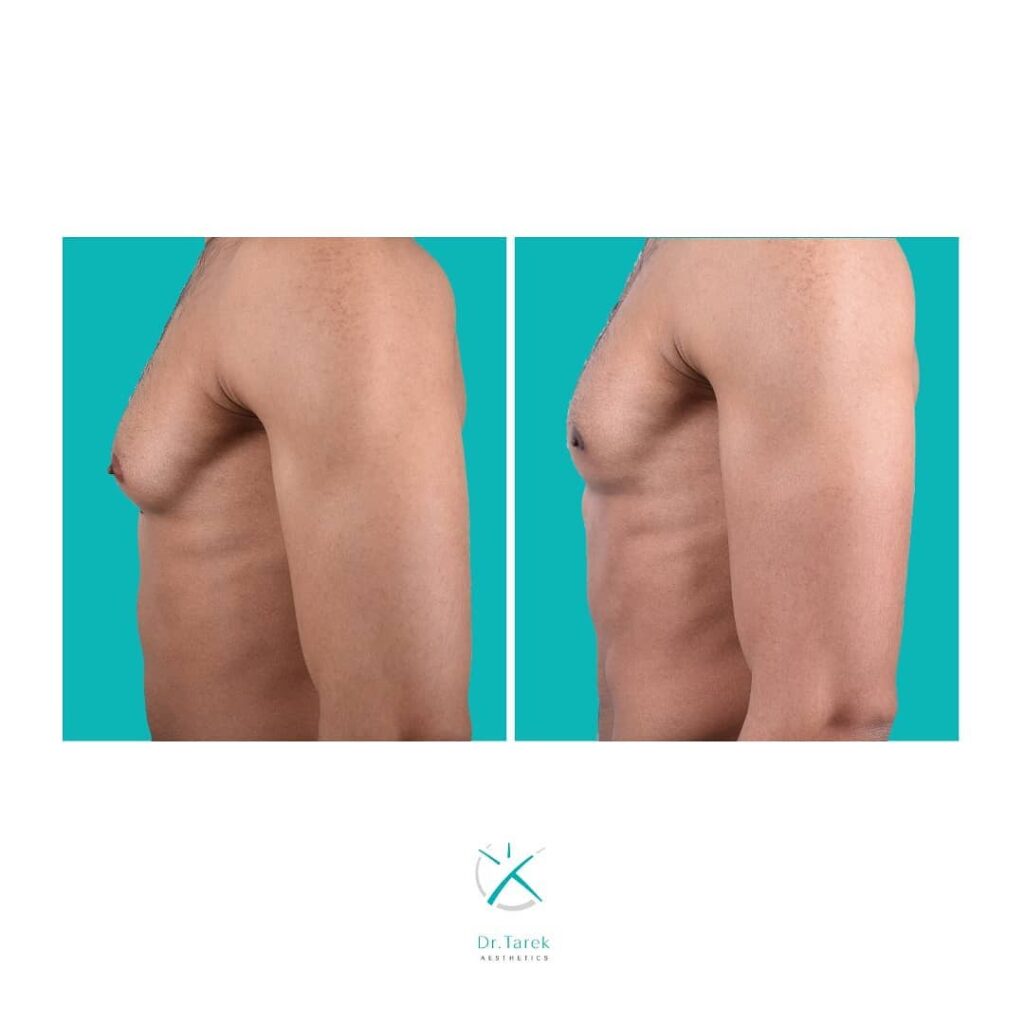 Men’S Liposuction Before And After