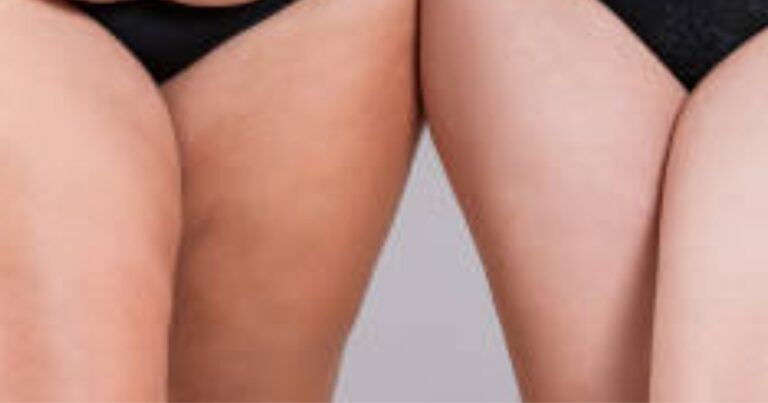 Leg Liposuction Before And After