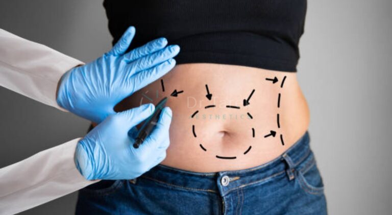 How Much Liposuction Can Be Done With A Tummy Tuck