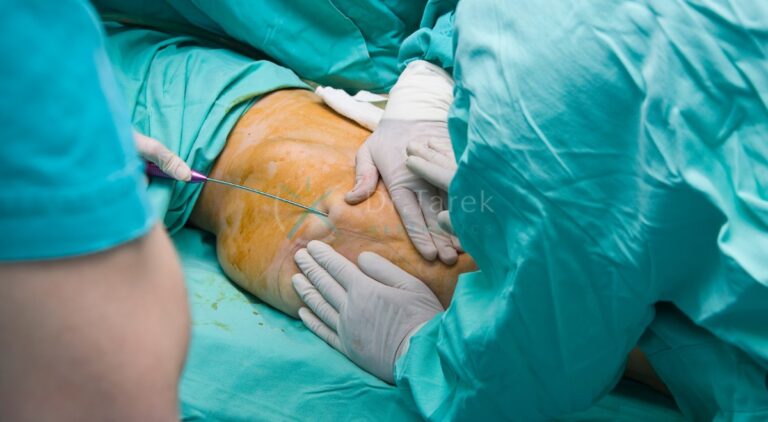 What Does Liposuction Cost