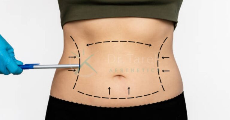 Are Liposuction Results Permanent