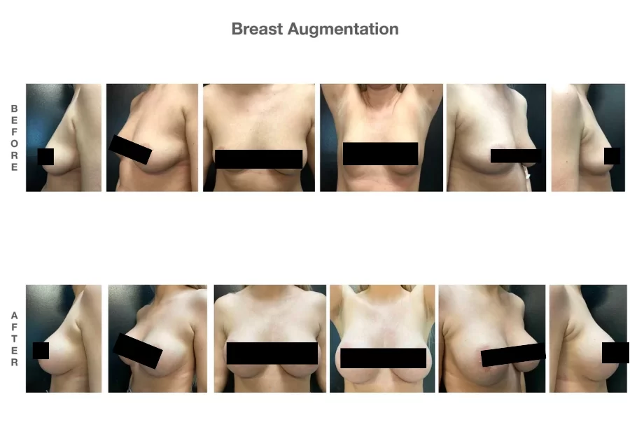 Breast-Augmentation-Gallery2-1
