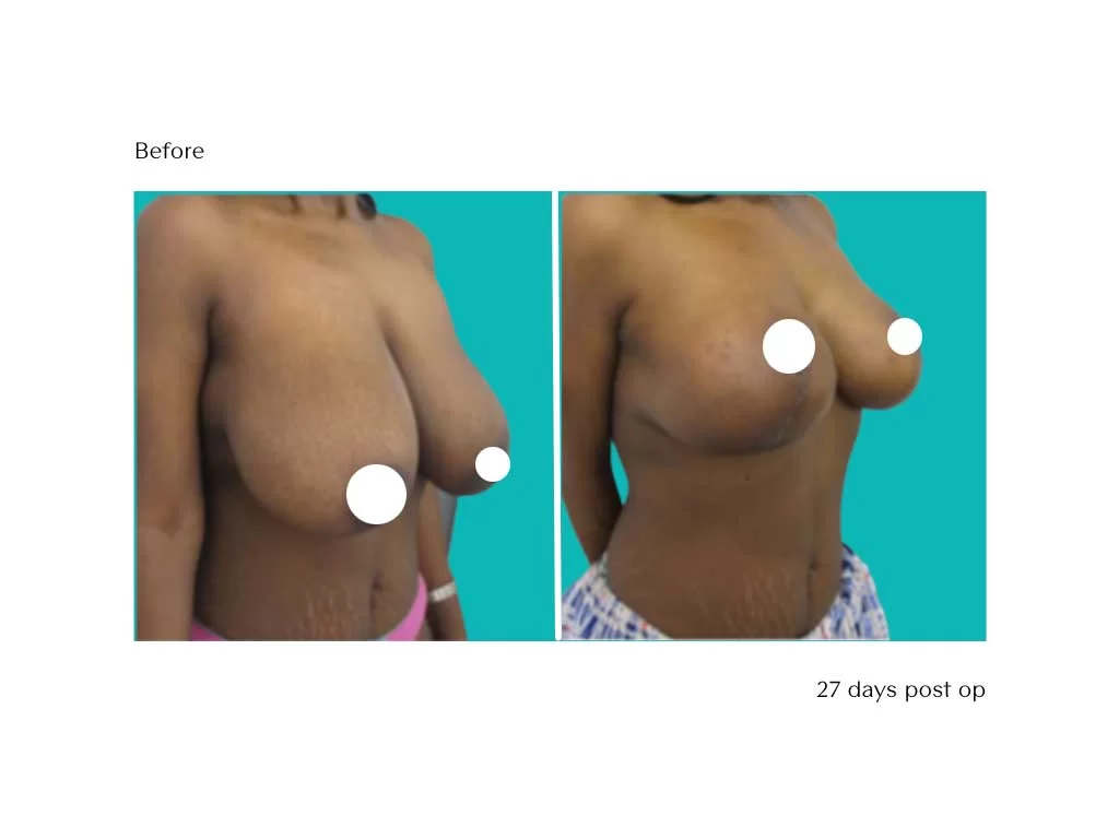 Breast-Reduction-1