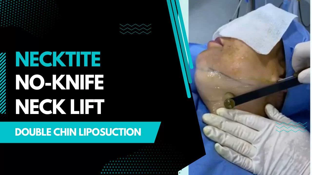 Double-Chin-Liposuction-Process