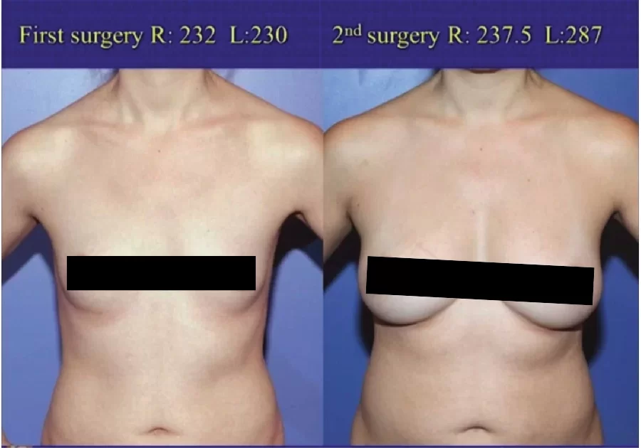 Breast Augmentation Gallery