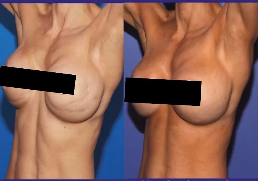 Breast Augmentation Gallery