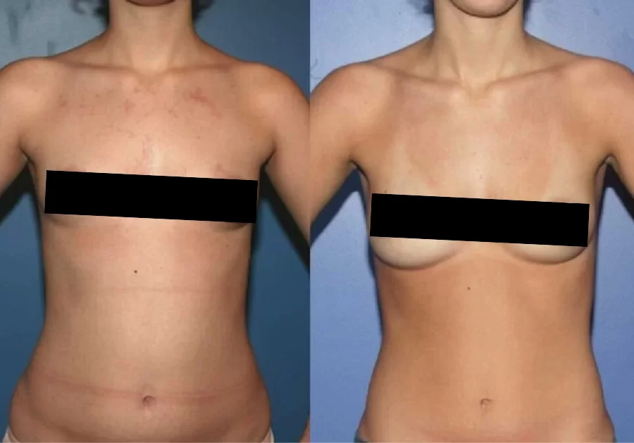 Breast Augmentation Gallery