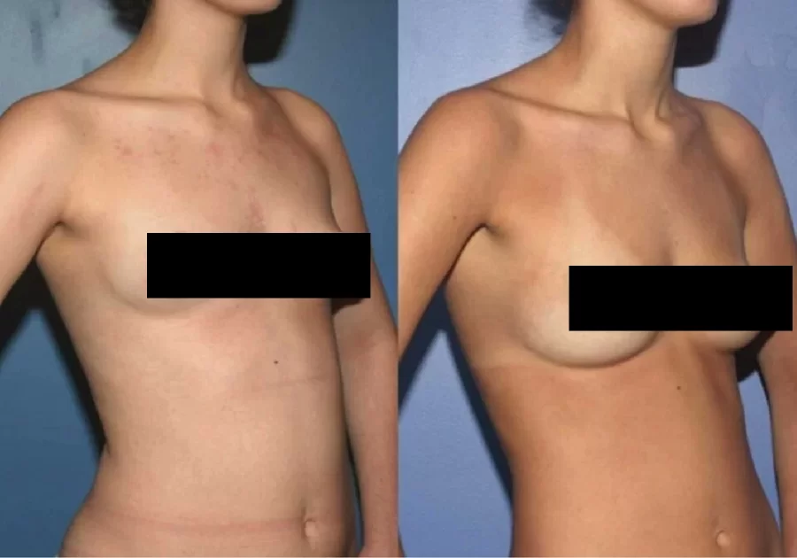 Breast Augmentation Gallery