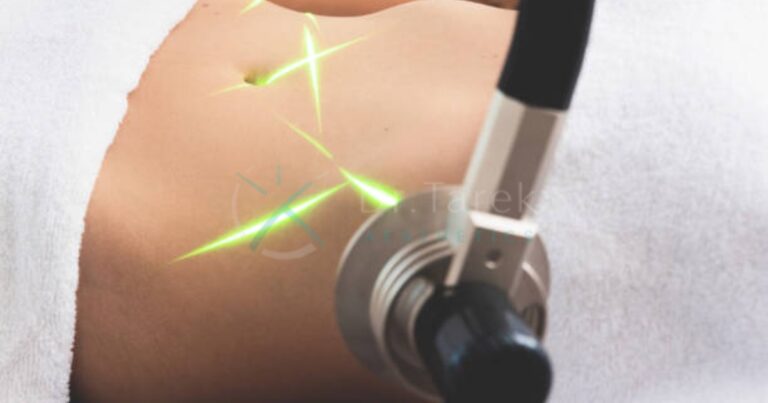 Is Lipo Laser Effective