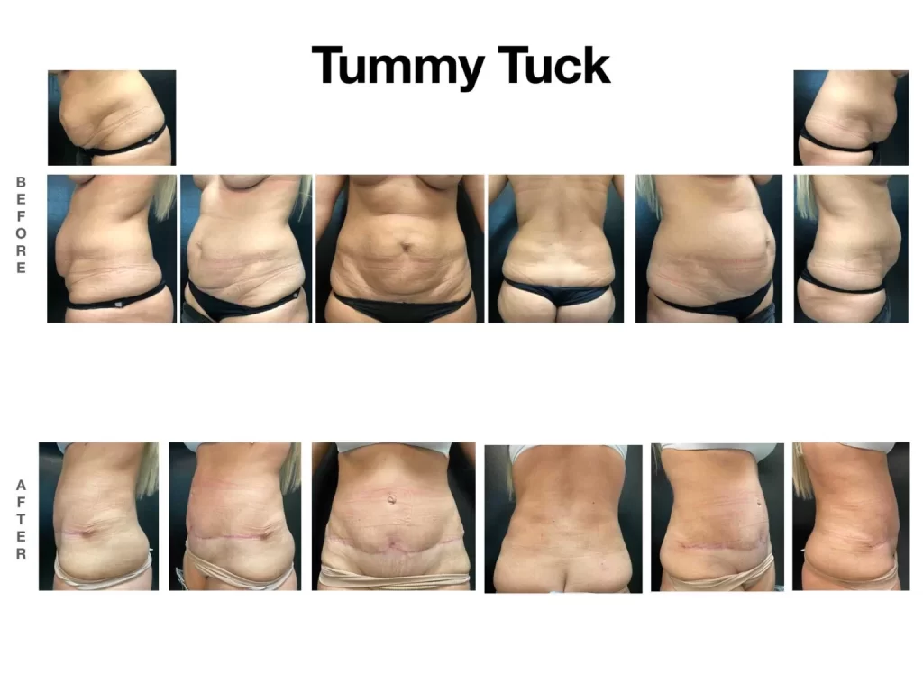 Tummy Tuck Gallery