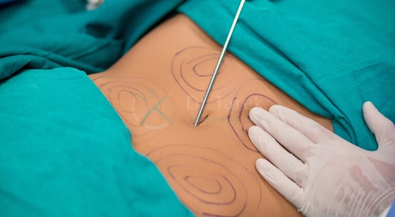 When Liposuction Is Performed For Medical Reasons