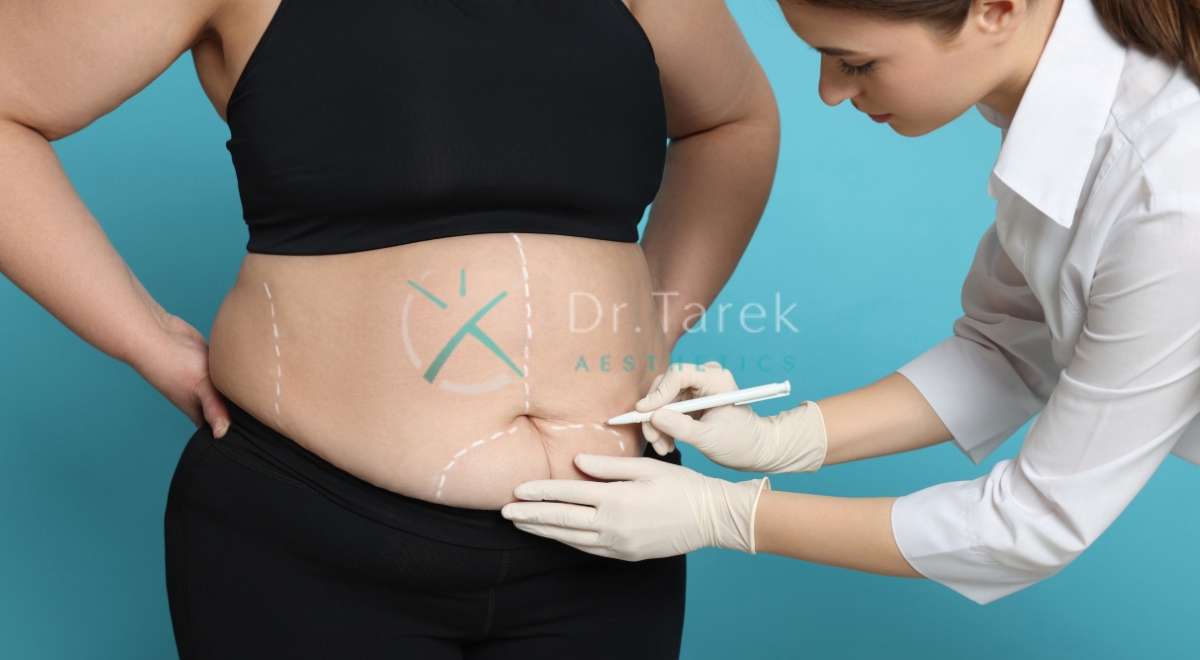 Where Can You Get Liposuction