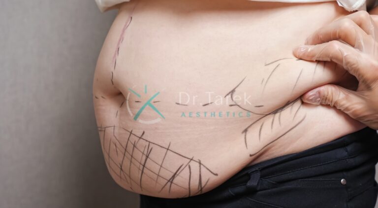 Where Does Fat Go After Liposuction