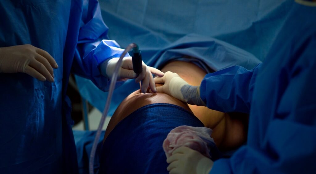 Liposuction Procedure In Dubai By Dr Tarek Bayazid